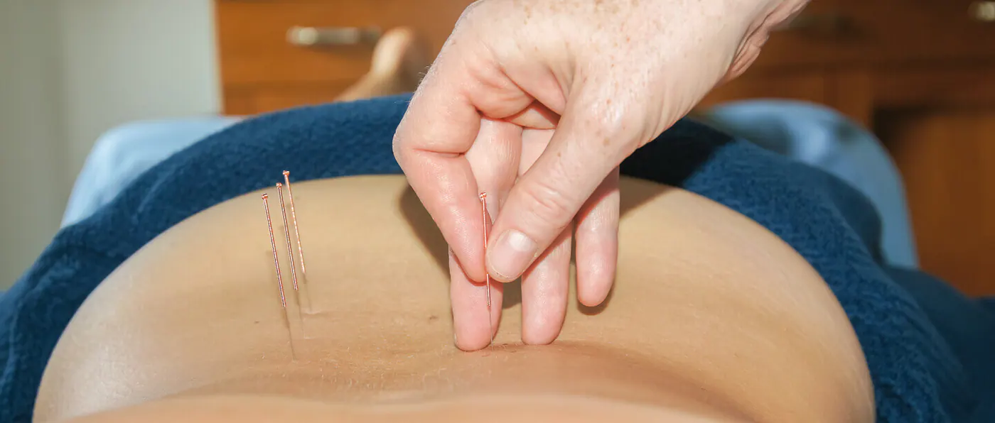 Acupuncture treatment at Boddhi Clinic