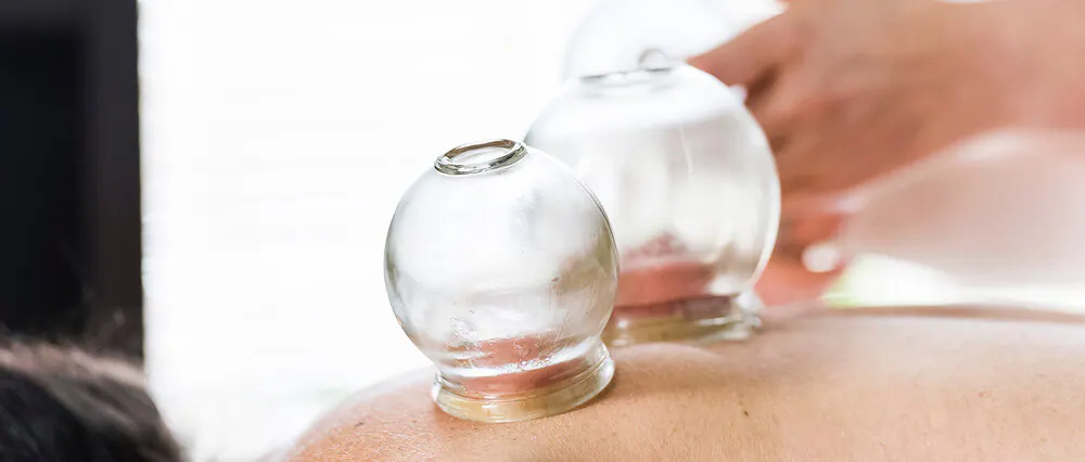 Glass cups used during a cupping treatment