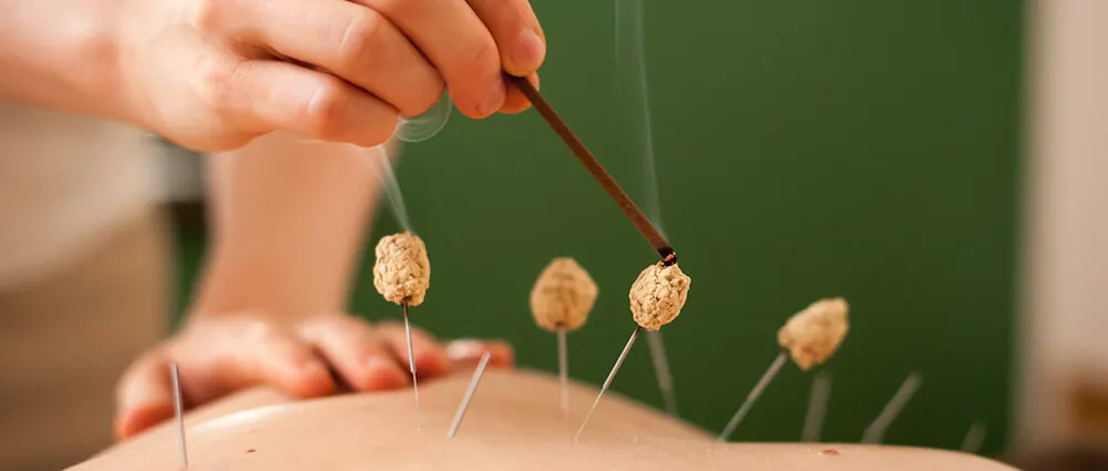 Moxibustion using a mugwort stick