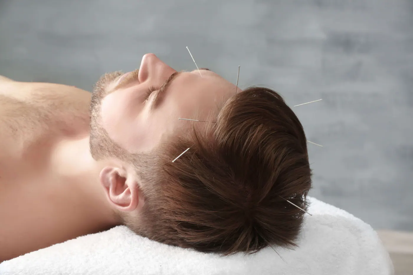 Scalp neuro-acupuncture treatment